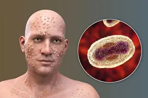 Rash Prints: Patient with smallpox (variola) and close-up of a smallpox virus