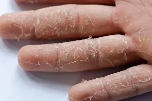 Dermatological Prints: Peeling skin on hand and fingers. Desquamation