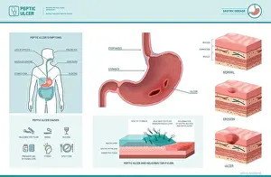 Inflammation Prints: Peptic ulcer and helicobacter pylori infographic with symptoms and causes