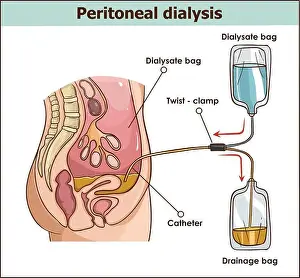 Kidney Prints: peritoneal dialysis are both used to treat kidney - vector illustration