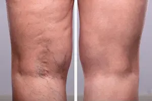 Knee Prints: A Person Knee's With Varicose Veins And Capillaries Before And After Medical Treatment