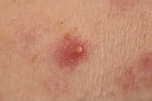 Skincare Prints: Pimple on acne skin. Pimple with visible blemishes