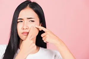 Acne Prints: Portrait teenage Asian beautiful young woman having skin problems squeezing pimples on her face