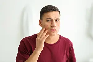 Worry Prints: Portrait of young man with acne problem at home