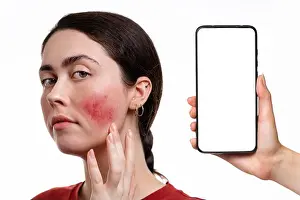 Inflammation Prints: Portrait of a young woman with rosacea on her cheeks