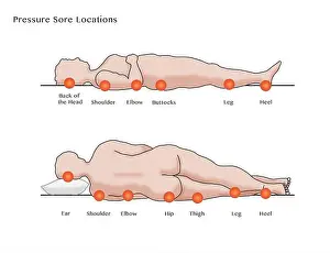 Sore Prints: Pressure Sore Locations, Diagram