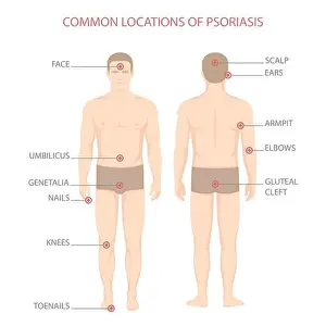Inflammation Prints: psoriasis illness diagram, human body skin disease