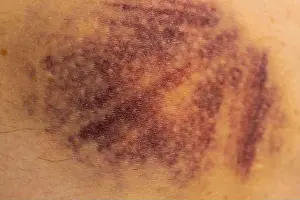 Examine Prints: Purple bruise on the skin, a large bruise formed on the human body after severe injury or mechanical injury to tissues