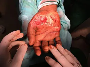 Sri Lanka Prints: Right hand palm laceration with tissue loss repaired with simple sutures allowing loss tissues to granulate