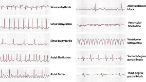 Sinus Prints: Schemes set of common electrocardiogram (ECG) abnormalities