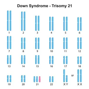 Symptoms Prints: Scientific Designing of Down Syndrome (Trisomy 21) Karyotype