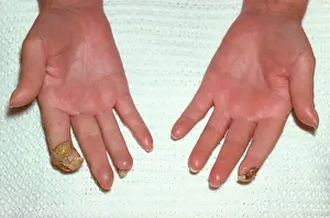 Index Finger Prints: Scleroderma - index finger sequestration