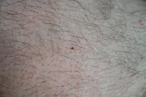 Dermatology Prints: A single freckle isolated on a leg covered in hair