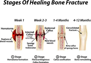Fracture Prints: Stages Of Healing Bone Fracture