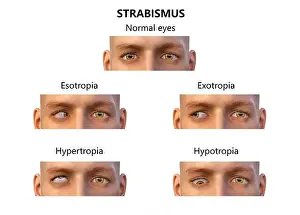 Disorder Prints: Strabismus types, computer illustration