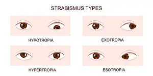 Upward Prints: Strabismus types. Hypotropia, hypertropia