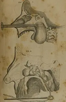 A system of surgery (Volume 4). plate xxxn. PLATE YTXTTT