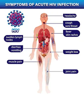 Well Being Prints: Symptoms of acute HIV infection illustration