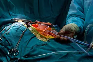 Pathology Prints: Teamwork surgeons during open heart surgery doctor holding surgical instruments during medical procedure at clinic