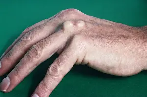Cholesterol Prints: Tendon xanthoma hypercholesterolaemia