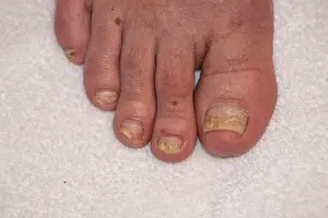 Odor Prints: Toenails infected by fungus can be seen being replaced by the healthy nail growth following the successful treatment