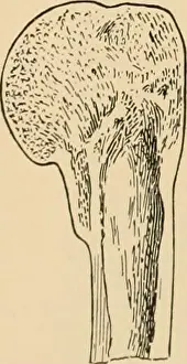 Bookyear1901 Prints: The treatment of fractures. j