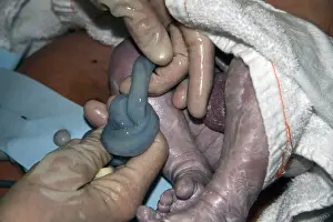 Knot Prints: A true knot in the umbilical cord at birth