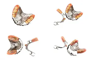 Orthodontics Prints: Upper and lower partial metal removable dentures set on white background