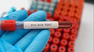 Check Up Prints: Uric Acid test result with blood sample in test tube on doctor hand in medical lab