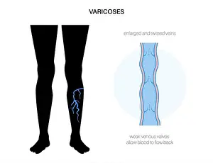Inflammation Prints: Varicose veins, illustration