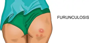 Hurt Prints: vector illustration of furunculosis on female buttocks