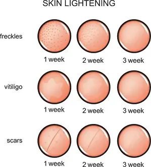 Whitening Prints: vector illustration of lightening of the skin. freckles, vitiligo, scars