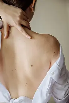Loose Prints: The back of a white girl with moles large and small