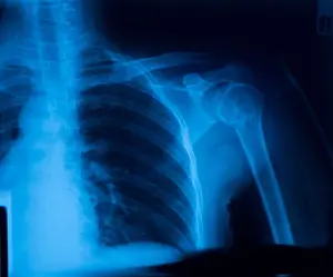 Black Body Prints: X-ray film of shoulder fracture