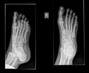 Toes Prints: x-ray of a foot showing a fracture in the proximal phalanx of the big toe on the righ foot of a 30 year old female