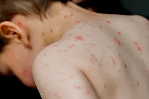 Infants Prints: A two year old boy suffers from Chickenpox. also known as varicella