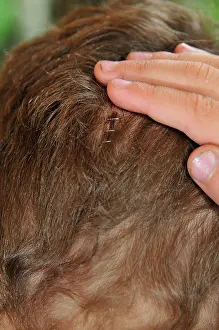 Wound Prints: The back of a young boys head with staples in it to heal a wound